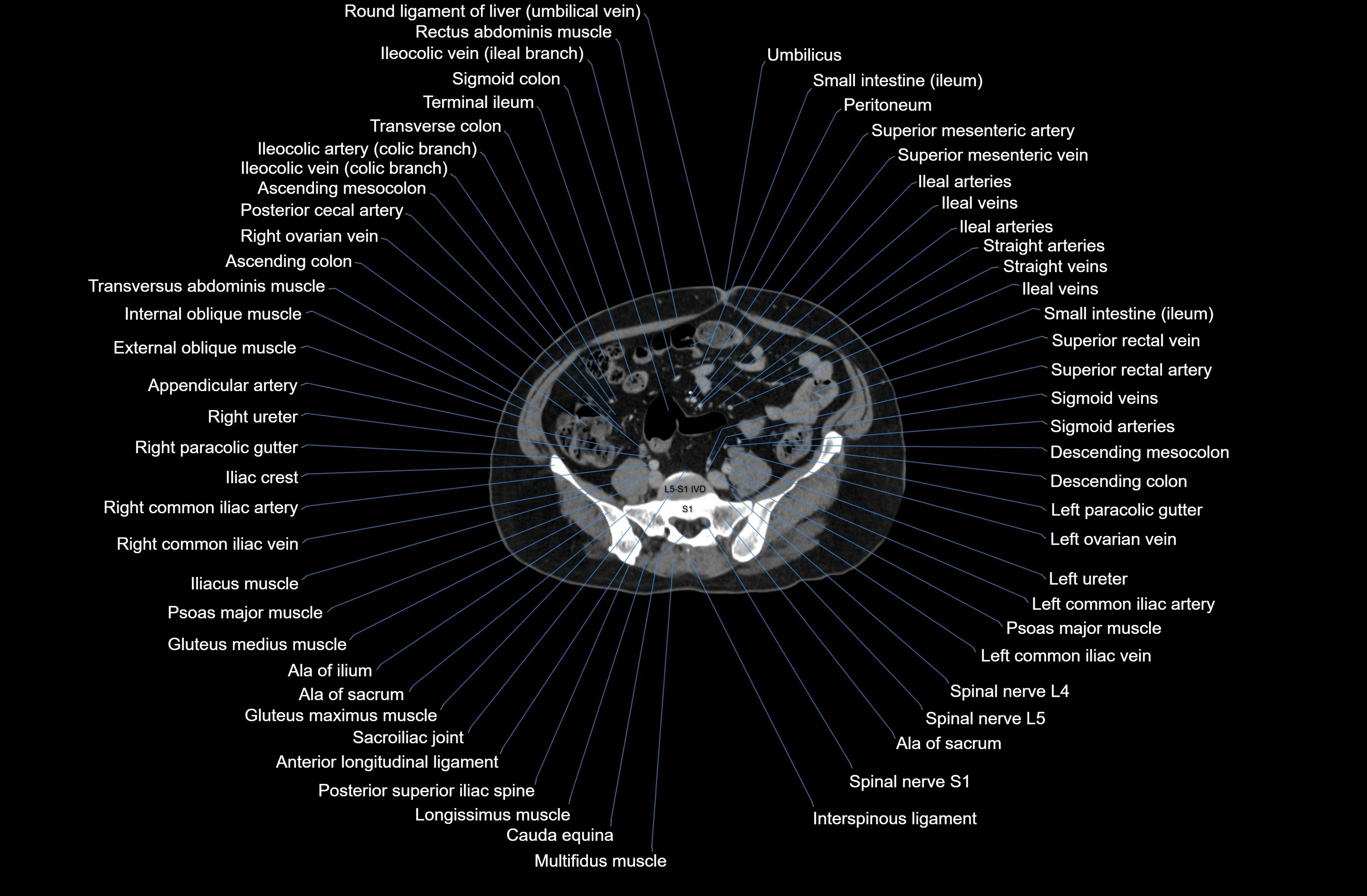 CT Abdomen axial cross sectional anatomy labelled radiology image-00064.webp